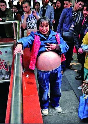 Wu Yuanbi, 53, suffers from Budd-Chiari syndrome, a chronic condition that causes the belly to fill with fluid. Wu Yuanbi, 53, suffers from Budd-Chiari syndrome, a chronic condition that causes the belly to fill with fluid.